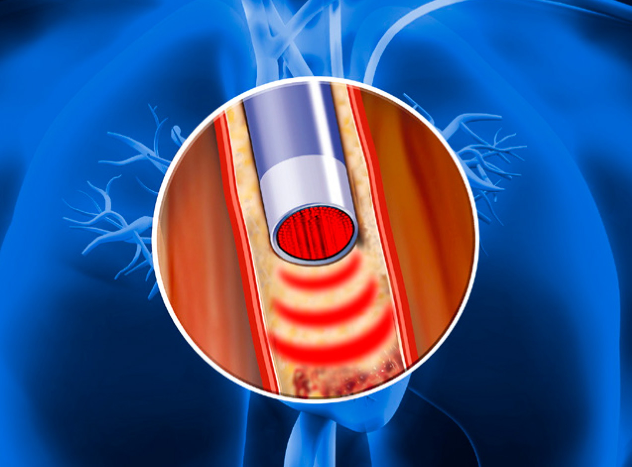 Endoscopy Illustration of an endoscope inside the heart