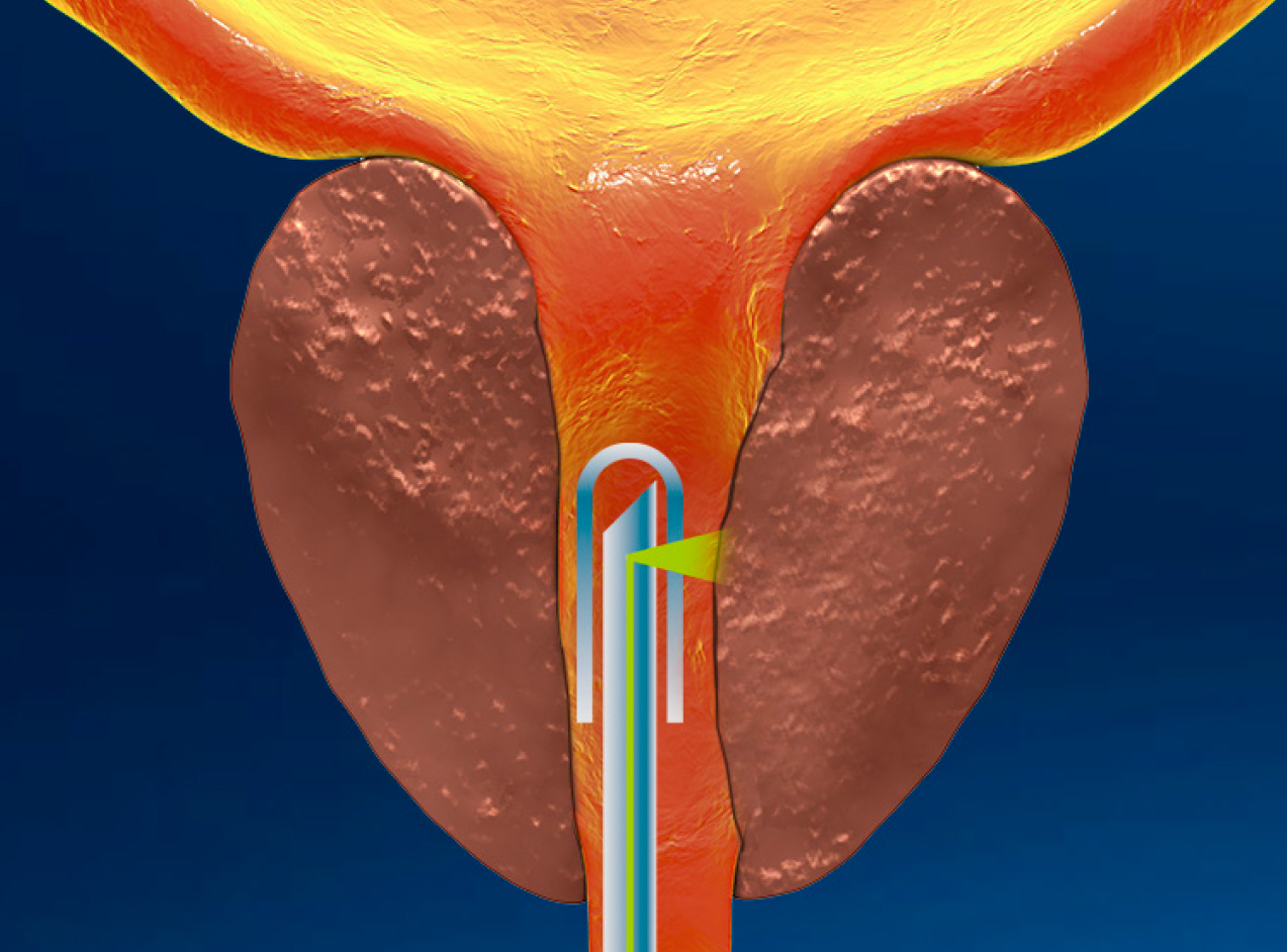 Prostate Disease Illustration of a probe measuring for enlarged prostate disease