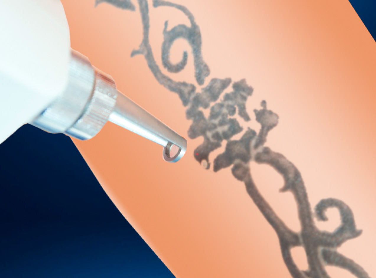 Tattoo Removal Illustration of a tattoo being removed by a laser device