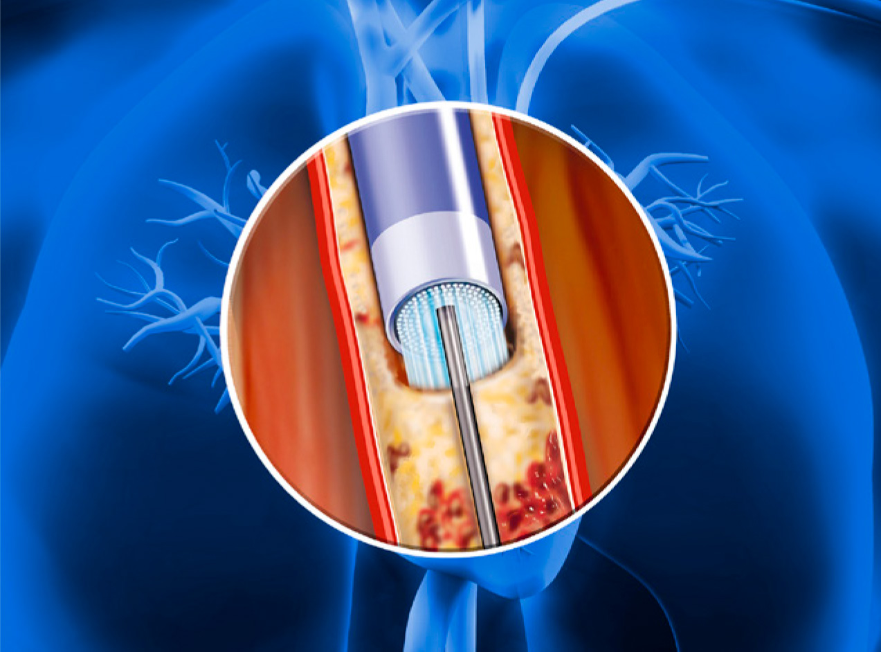 Arterial Blockage Illustration of blockage in the heart's arteries being removed