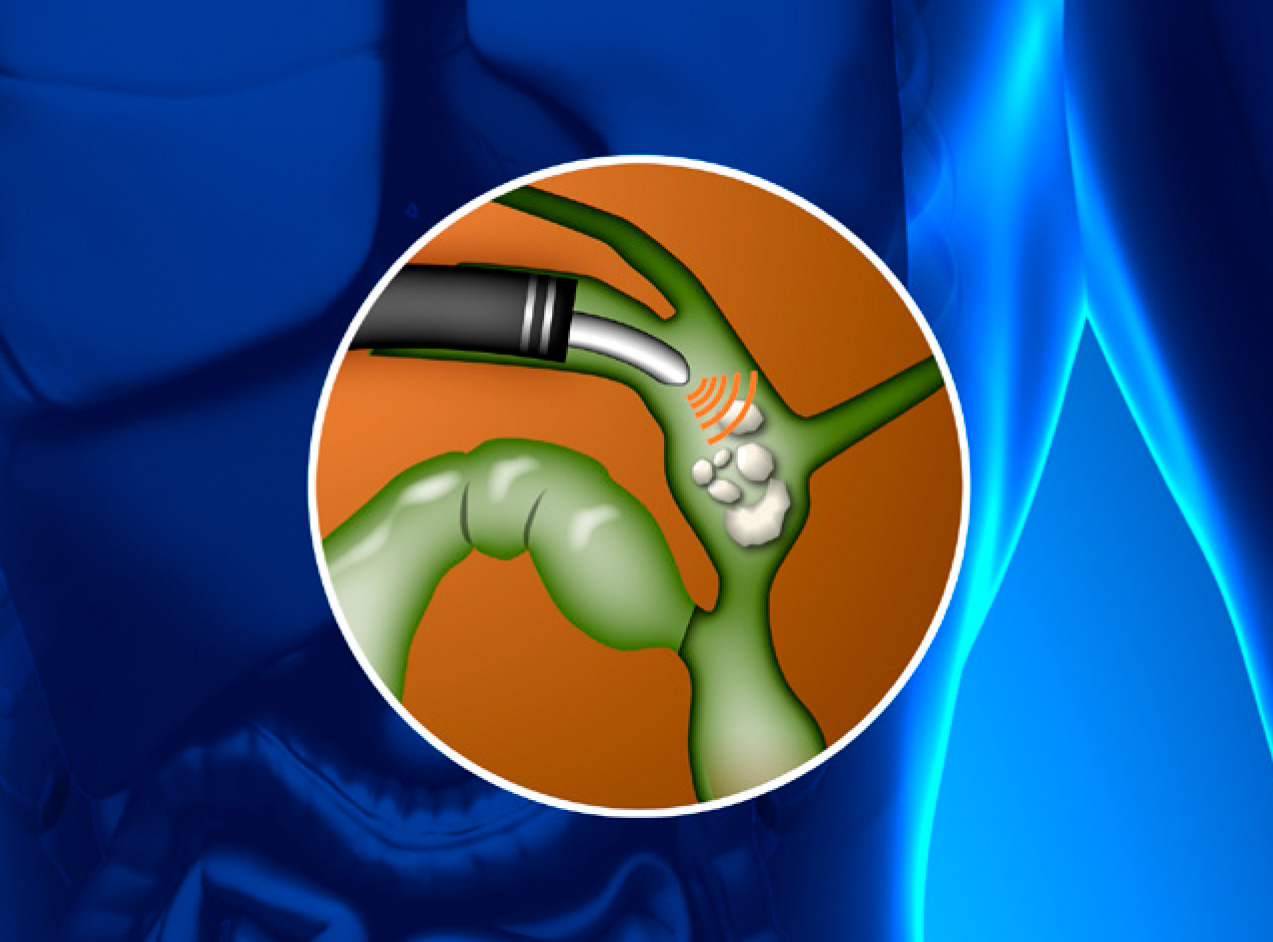 Lithotripsy Gall Bladder Illustration of gallstones being removed