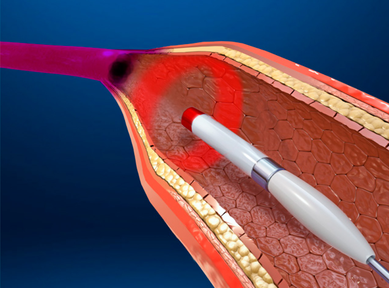 Vein Disease Illustration of vein disease treatment using fibers